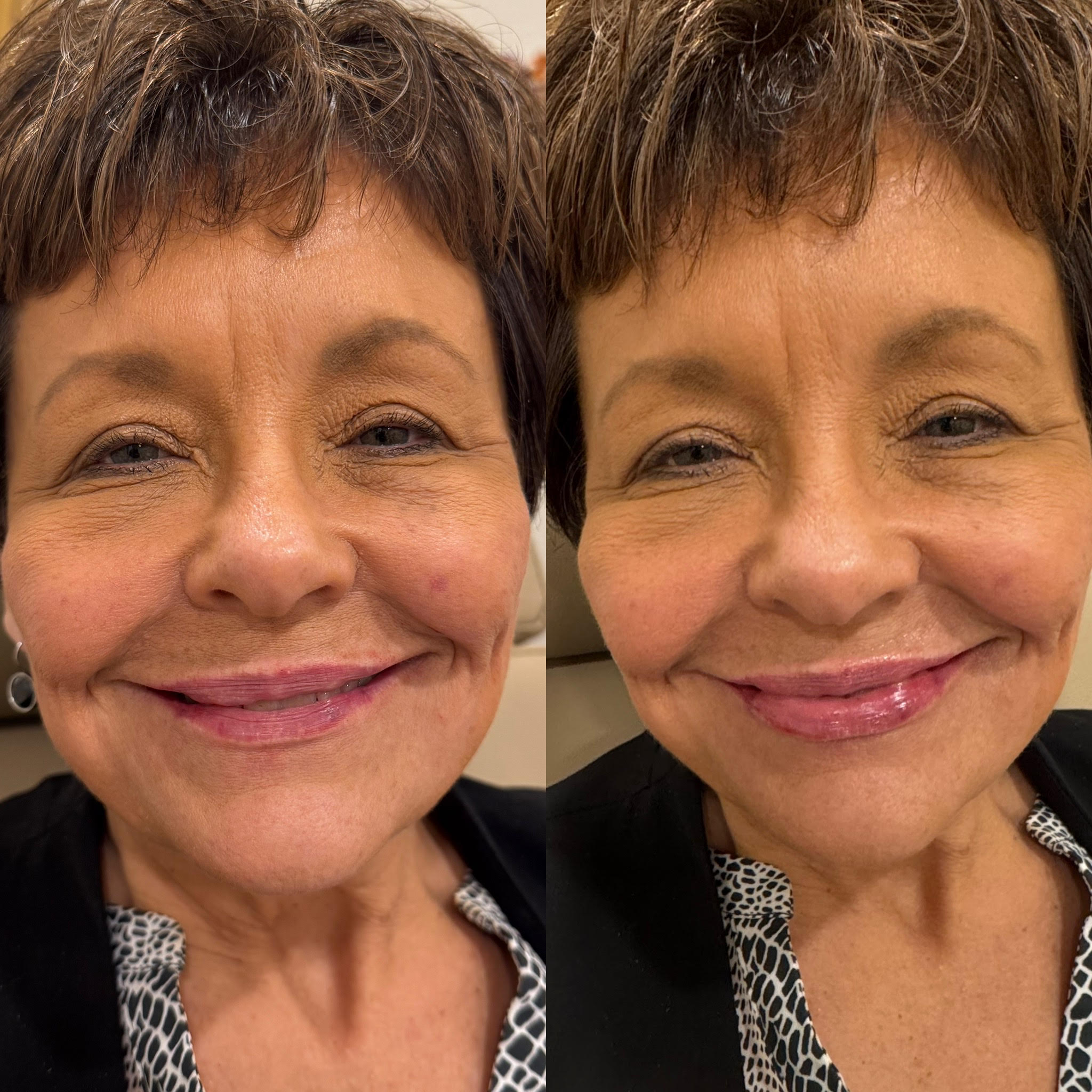 Lip Filler - Before & After